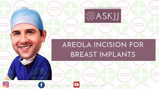 The pros and cons of using the areola incision for breast implants [upl. by Elrahc]