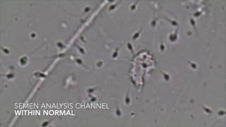 Semen Analysis  Within normal [upl. by Noramac493]