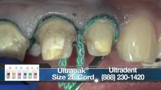 Replacing Crowns on Teeth 710 With BruxZir® Anterior [upl. by Plerre]