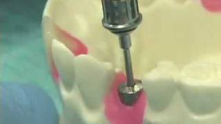 Placing Implant Abutments [upl. by Forlini]