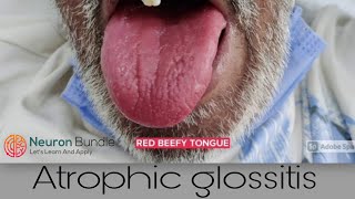 Atrophic glossitis BeefyRedTongue medschool clinicalexamination [upl. by Aketahs]