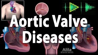 Aortic Valve Disease Animation [upl. by Rednav673]