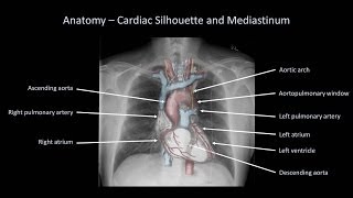 How to Interpret a Chest XRay Lesson 2  A Systematic Method and Anatomy [upl. by Pollock]