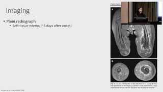 Osteomyelitis Acute and Chronic [upl. by Atlas297]