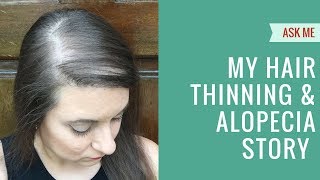 Hair Thinning Balding amp Bald Spots My Alopecia Story [upl. by Sanferd413]