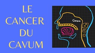 Le cancer du cavum en 5 points [upl. by Nahsez]