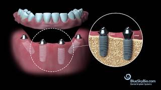 Blue Sky Bio Multi Unit Abutment [upl. by Winston]