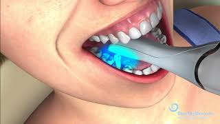 Optical IntraOral Scanning Procedure [upl. by Sukey883]