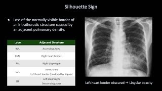 How to Interpret a Chest XRay Lesson 8  Focal Lung Processes [upl. by Aketal]