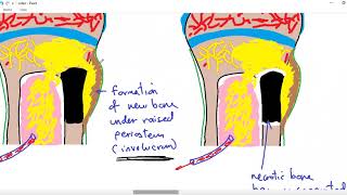 Osteomyelitis And Minimally Invasive Foot Surgery [upl. by Niltiac]