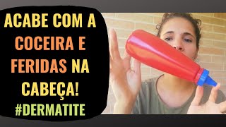 ELIMINE a Coceira e Feridas na cabeça dermatite [upl. by Wanda]