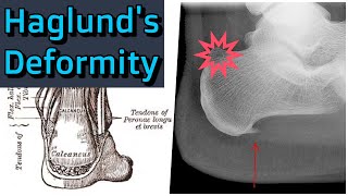 Haglunds Deformity [upl. by Agee]