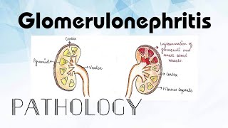 Glomerulonephritis Pathology [upl. by Nahtnamas]